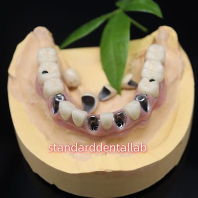 satın al Dental implantlar metal seramik taçlar Malo köprüsü çevrimiçi üretim