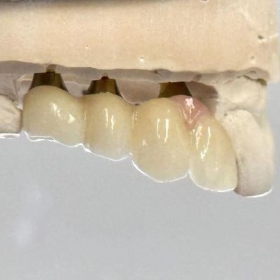 satın al Porselen Zirkonya Çimento Geri Alınmış vida implant Özel Uyumlu Estetik için Altıgen Baş Şekli çevrimiçi üretim