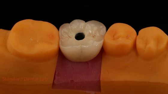 satın al Dental Laboratuvarı'ndan viski tutulmuş PFZ Porselen Katmanlı Zirkonya Diş İmplantı Tacı ISO FDA CE 5 yıllık garanti ile sertifikalı çevrimiçi üretim