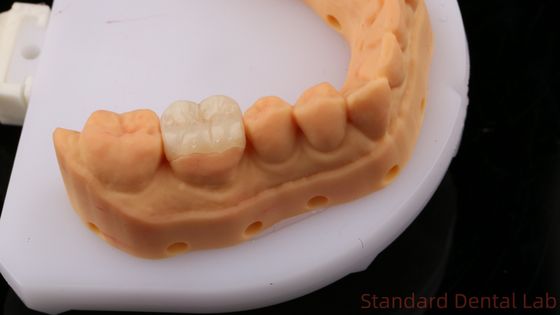 satın al Transparanslı Zirkonya Diş Eklentileri Doğal Çürük Şeklini Geri Getirmek İçin Onlay Taç / Standart Diş Laboratuvarı çevrimiçi üretim