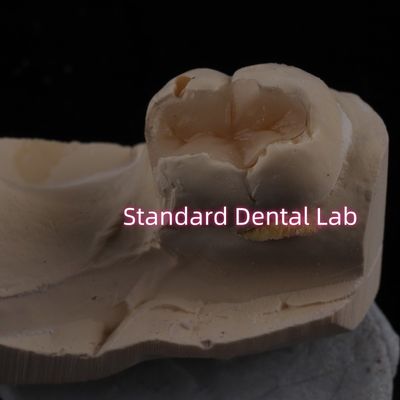 dökme porselen diş inlay Onlay Overlay Zirconia Emax Yüksek Estetik