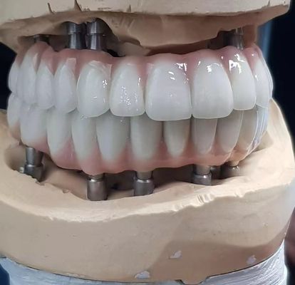 Doğal görünümlü dişler için kullanılan, hassas bir şekilde yapılmış zirkonya implantı vida çimento