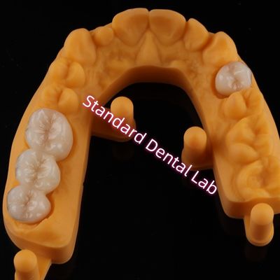 Taç Tüm Porselen Seramik Zirkonya Ivoclar Estetik Dişler OEM