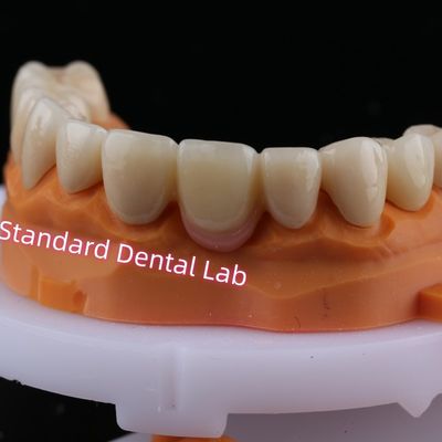 Dijital CAD CAM frezeleme pembe porselenli katmanlı zirkonya köprü tacı