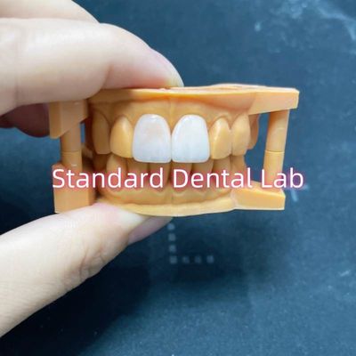 Yüksek Renk Dayanıklılığı Ivoclar Emax Laminat Finerler Yüksek Şeffaflık