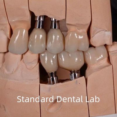 Doğal görünümlü estetik vida tutulmuş zirkonya implant tacı