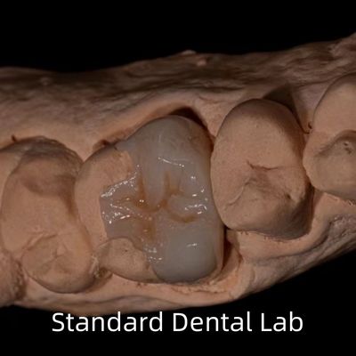 Transparanslı Emax Zirkonya Diş Eklentileri Doğal Çürük Şeklini Geri Getirmek İçin Onlay Taç