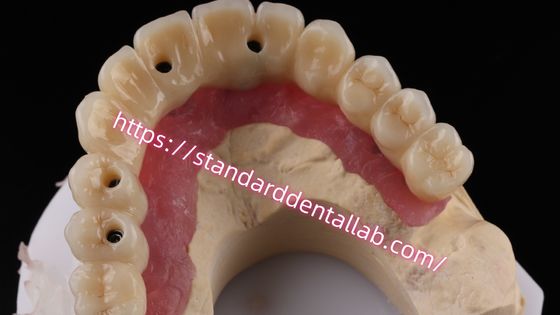 Çeşitli katmanlı zirkonya vidalı implant köprüsü metal yapıda biyolojik uyumludur