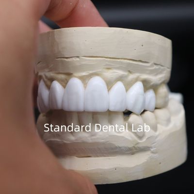Diş taçları, teşhis, diş balığı, Çin Diş Laboratuvarı'ndan yüksek estetik.