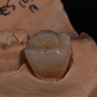 Estetik olarak hoş sonuçlar için tam konturlu şeffaf zirkonya tacı