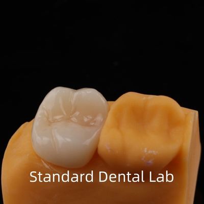 5 Yıllık Garanti Molar Dişleri için Tam Kontürlü Zirkonya Tacı Noritake Porselen Güvenilen Diş Laboratuvarı tarafından Yapıldı