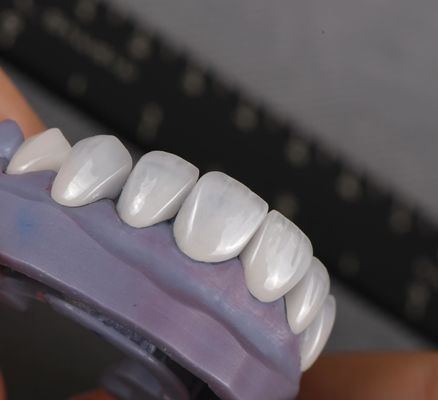 Doğal görünümlü Emax Veneers Crown Biyokompatibilite Minimum Hazırlıkla Beyazlama Gölgesi