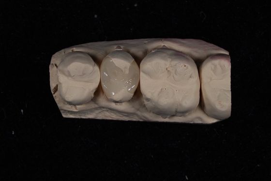 Güç Emax Seramik Finerler Tacı Mükemmel leke direnci / biyolojik uyumluluk