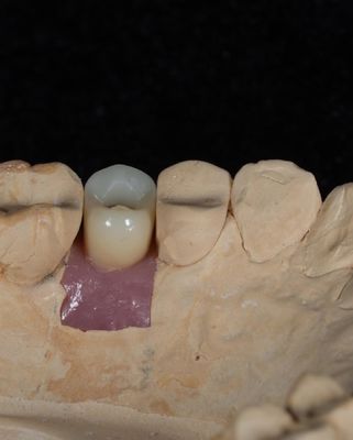 5 yıllık garanti ile uzun süreli diş implantları için vida çimento tutulmuş implant