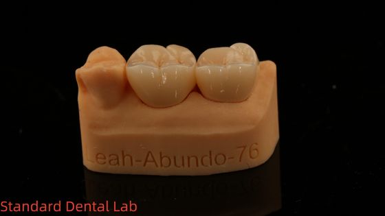 Sabit Diş Laboratuvarı Taçları 3D Pro Yüksek Şeffaflık Tam Zirkonya Taçları 5 Yıllık Garanti