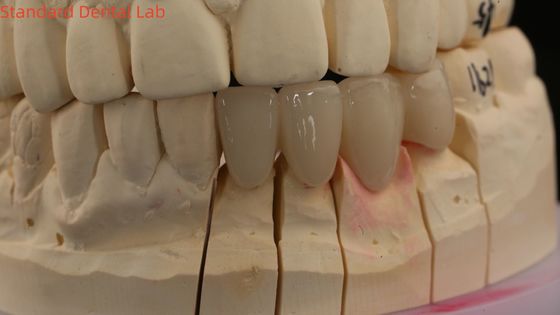 Sabit Diş Laboratuvarı Taçları 3D Pro Yüksek Şeffaflık Tam Zirkonya Taçları Vita Gölgesi Özel