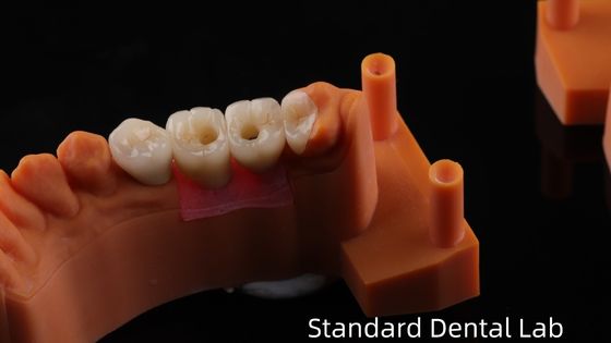 PFZ porselen katmanlı zirkonya ile viski tutulmuş diş implantı tacı 5 yıllık garanti ve 3D baskı modeli