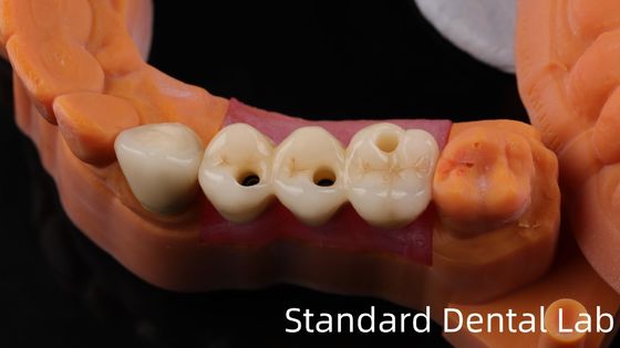 Profesyonel Zirkonya Diş İmplantı Tacı Titanyum CAD CAM Zirkonya Tacı Çin Diş Laboratuarı