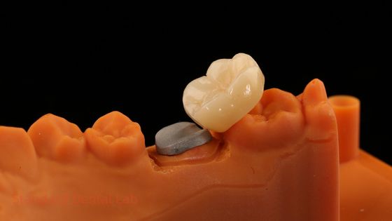 Yüksek Estetik Dental Laboratuvarı ve SDL Dental Laboratuvarı'ndan Daha İyi Teknisyenler