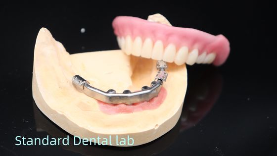 Titanyum İmplant Desteklenmiş Diş Dişleri Implantlar Üzerine Kesin Ivoclar Diş Dişleri