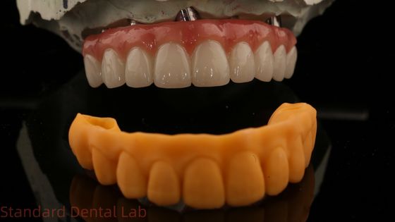 5 Yıllık Garanti Diş İmplantı Tacı PMMA Köprüsü Çok Birimli Abutments Üzerine Özel Vita Gölgesi