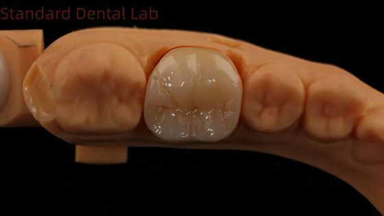 Noritake Porselen 3B baskı modeli ile Dental Dijital Tam Zirkonya Tacı 5 Yıllık Garanti