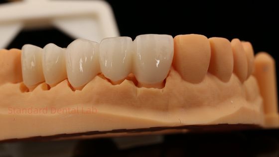 Yüksek Estetik Ön Dişler Tam Kontürlü Zirkonya Tacı Özel Vita Gölge Diş Laboratuarı ile