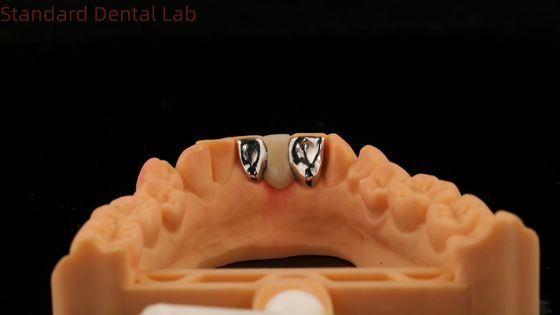 Dental PFM Maryland Bridge Yüksek Estetik FDA Sertifikalı Vita Porselye Çin Dental Laboratuvarı