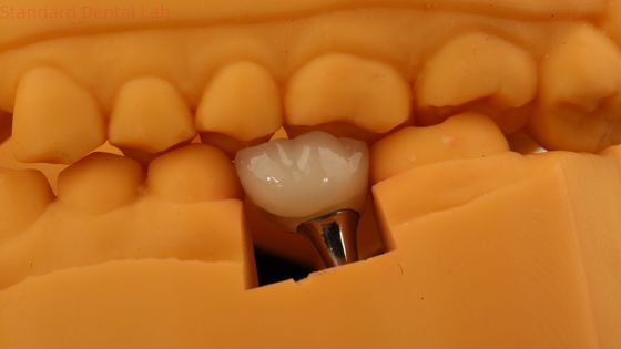 3D baskı modeli ile vida tutulmuş diş implantı tacı