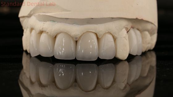 Çin Diş Laboratuvarı Zirkonya Tam Kontürlü Taç Yüksek Estetik Doğal Diş Köprüsü 5 Yıllık Garanti