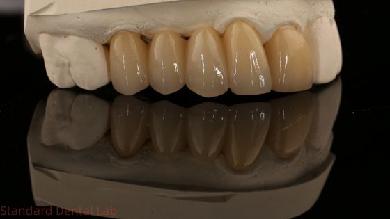 Noritake Porselen Tam Kontür Zirkonya Tacı Yüksek Estetik Doğal Özel Zirkonya Diş Köprüsü