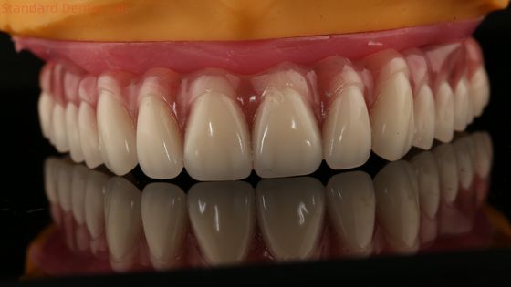 Akrilik kısmi implant diş protezi üzerinde Tizyum çubuğu Tam diş protezi Dişler kurulmuş vida tutulmuş