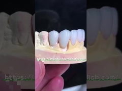 Doğal görünümlü Emax Veneers Crown Biyokompatibilite Minimum Hazırlıkla Beyazlama Gölgesi
